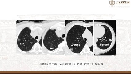 肺部结节怎么治疗