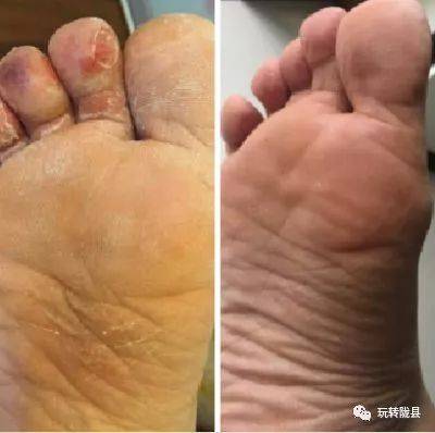 脚板烂了是怎么回事
