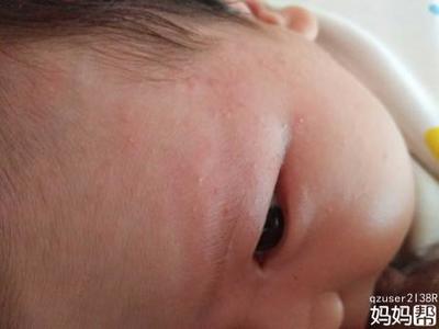 脸上突然才小痘痘