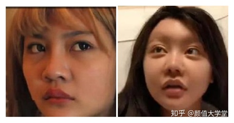 隆鼻等老了以后后遗症