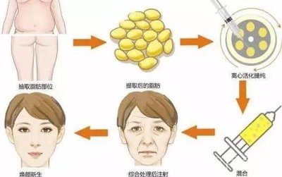 玻尿酸填充鼻子后遗症