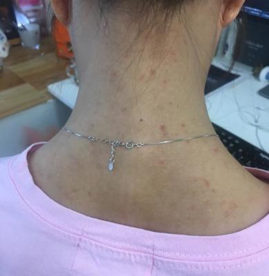 背上长痘痘是在排毒吗