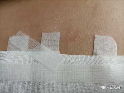 疤痕放疗