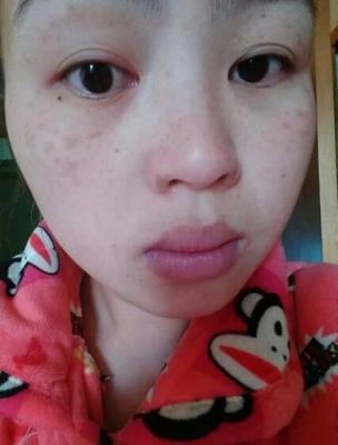 产后脸上长痘痘用什么药