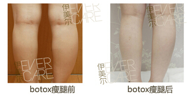 打botox瘦腿价格