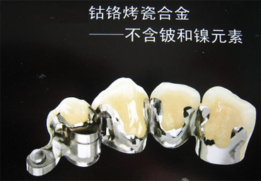 合金烤瓷牙