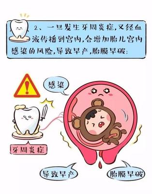 孕妇牙周炎