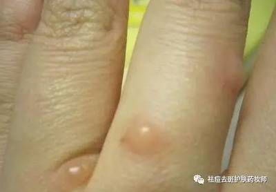汗疱疹怎么治疗