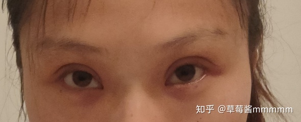济南曲梅双眼皮