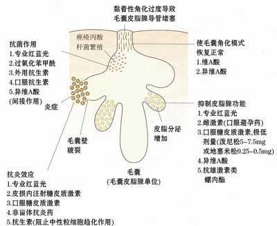 蓝光祛痘原理