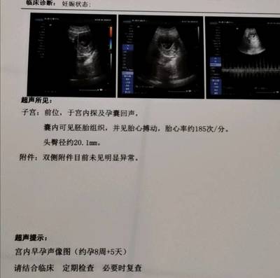 孕9周胎儿