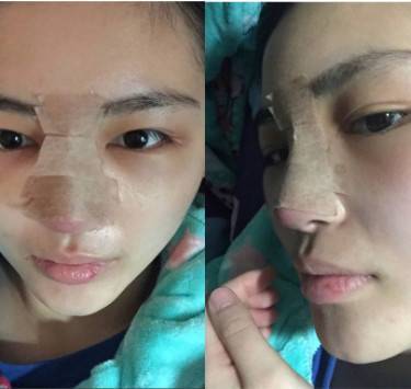 隆鼻等老了以后后遗症