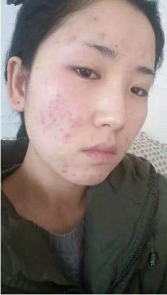 珍珠粉能去背上的痘痘吗