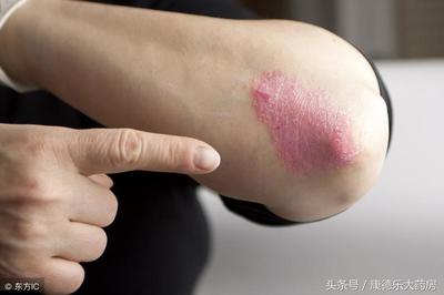 小孩的湿疹怎么治疗最好方法