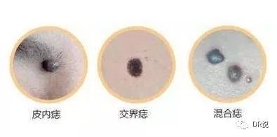 医院去黑痦子多少钱