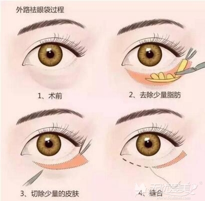 丹东去眼袋价格是多少