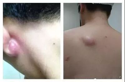 粉瘤和痘痘的区别
