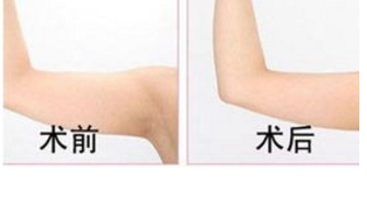 抽脂减肥效果怎么样