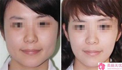 埋线一般要多少钱