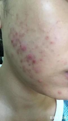 痘痘严重到快烂脸了