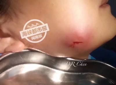 孕妇智齿疼怎么办