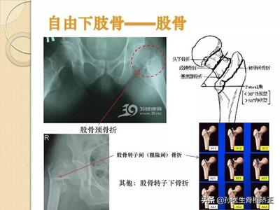 骨颈骨折后几个月能好