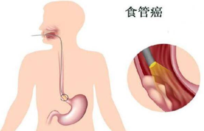 食道疼是怎么回事