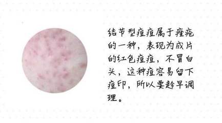 痘痘流脓可以贴痘痘贴吗