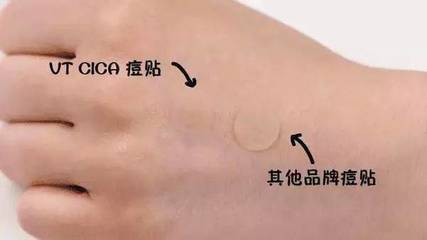 痘痘流脓可以贴痘痘贴吗