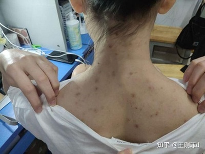 肩膀长痘痘是怎么回事