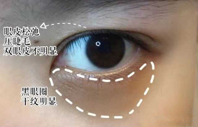 眼袋大是怎么回事