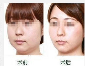 脸抽脂