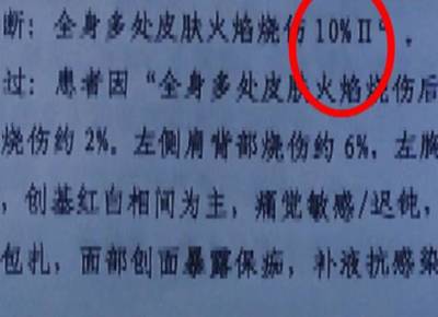 烧伤十级伤残最新标准