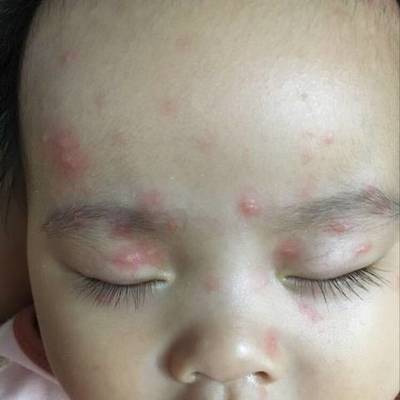 新生儿单纯疱疹病毒感染