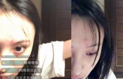 挤痘痘会导致红血丝吗