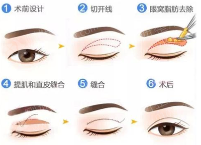 自贡做双眼皮价格