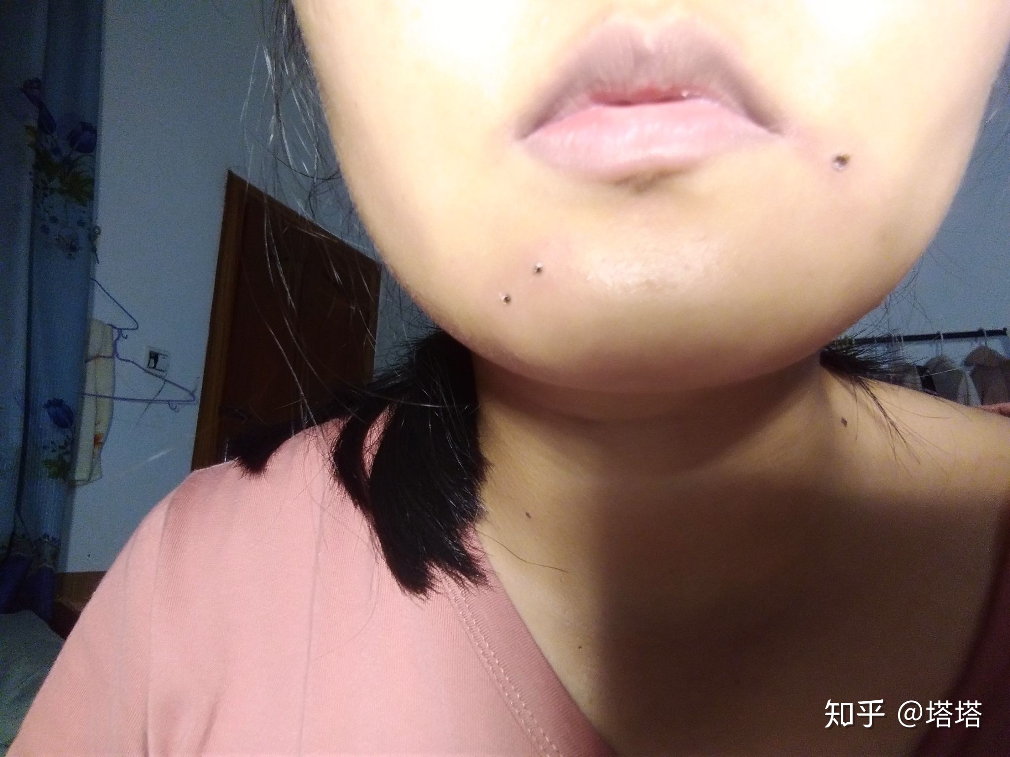 药水点痣后的恢复过程