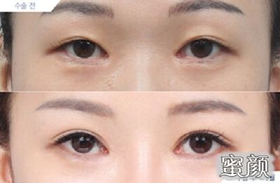 割了双眼皮多久可以碰水