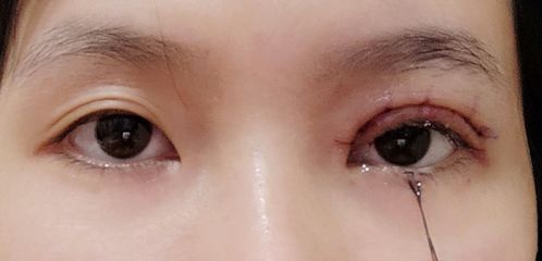小儿眼睑下垂怎么治疗