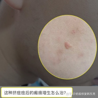 容易长痘痘怎么治