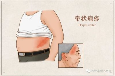 带状疱疹后遗神经痛怎么治疗