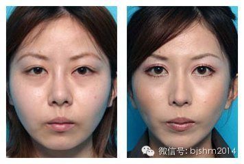 botox注射瘦脸效果
