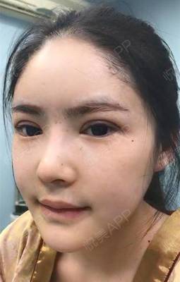 割了双眼皮能看手机吗