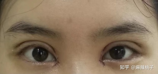 沈阳 双眼皮