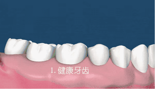 有牙周炎的口腔全景片怎么看