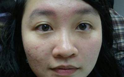化妆之后脸上长痘痘
