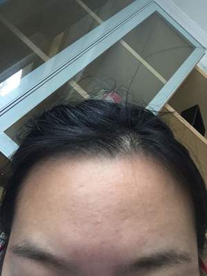 下巴经常长痘痘有白斑