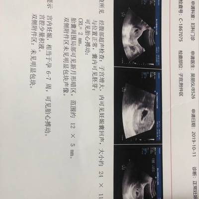 孕妇白带有血丝是怎么回事