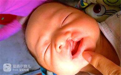 胎儿兔唇是什么原因造成的