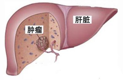 肝上有肿瘤该怎么治疗生存多久
